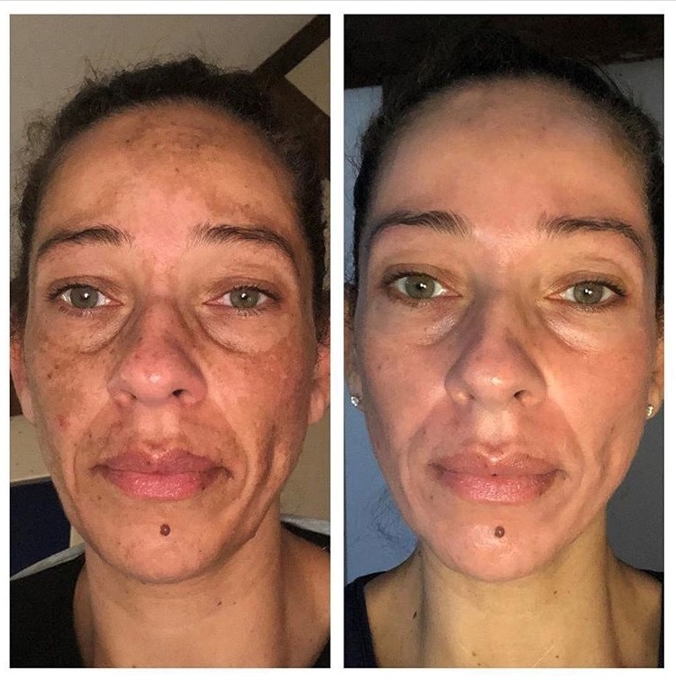 Facial Raleigh NC