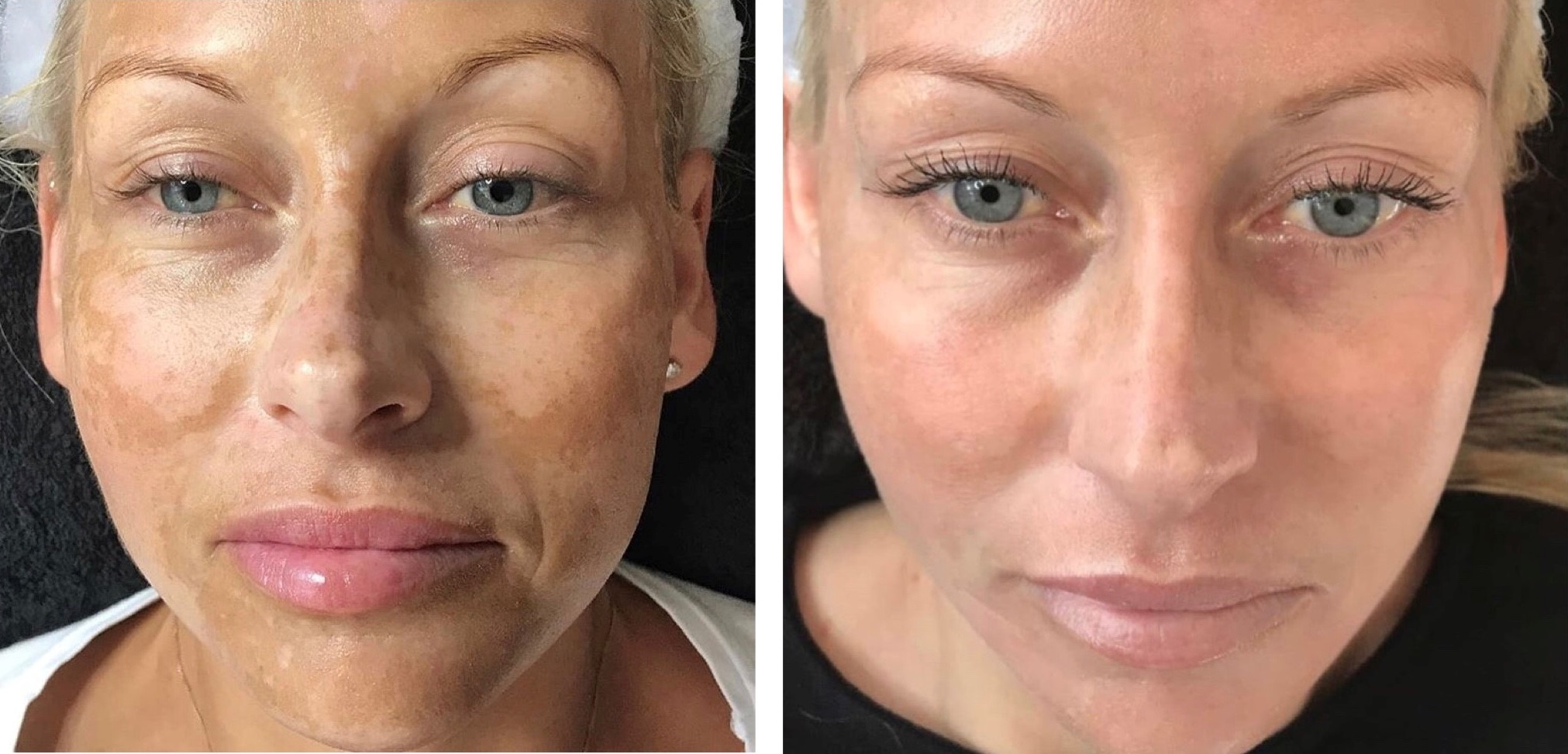 Cosmelan Peel Treatment