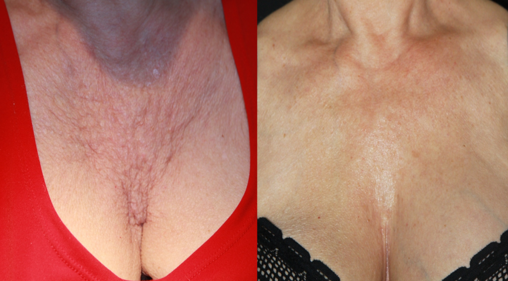 Can PRP Therapy Tighten Loose Breast Skin?
